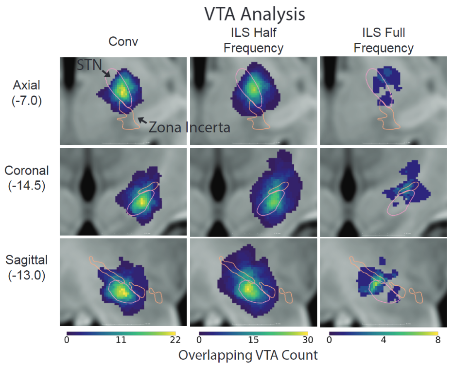 Axial, Coronal, and Sagittal brain views showing the overlapping VTA counts